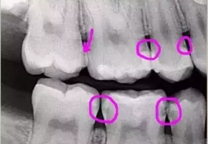 看牙齒為什么要拍片？