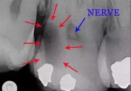 看牙齒為什么要拍片？